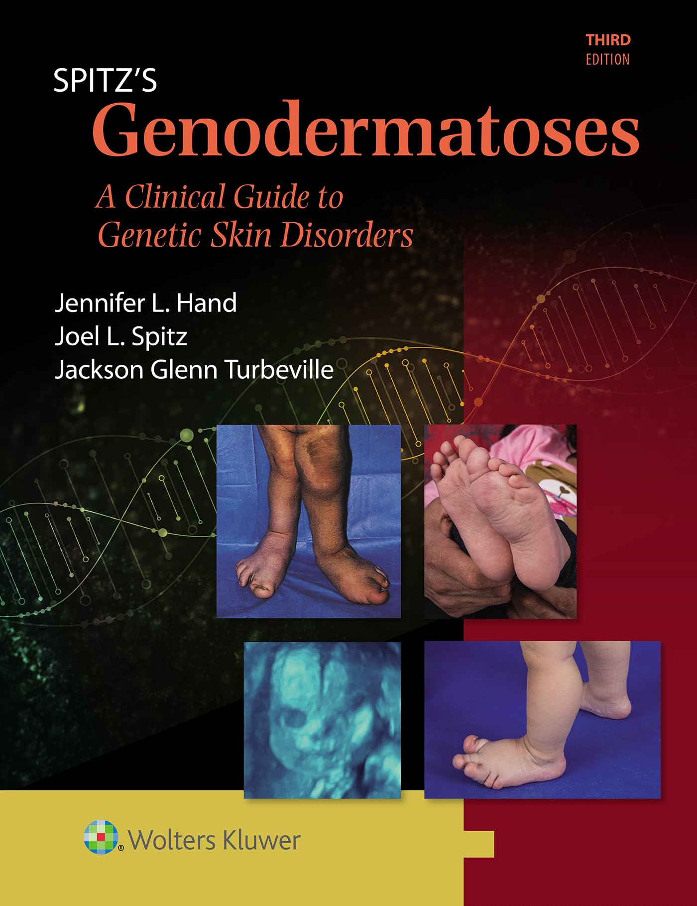 Buy Spitz's Genodermatoses: A Full Color Clinical Guide to Genet — BookShops.in
