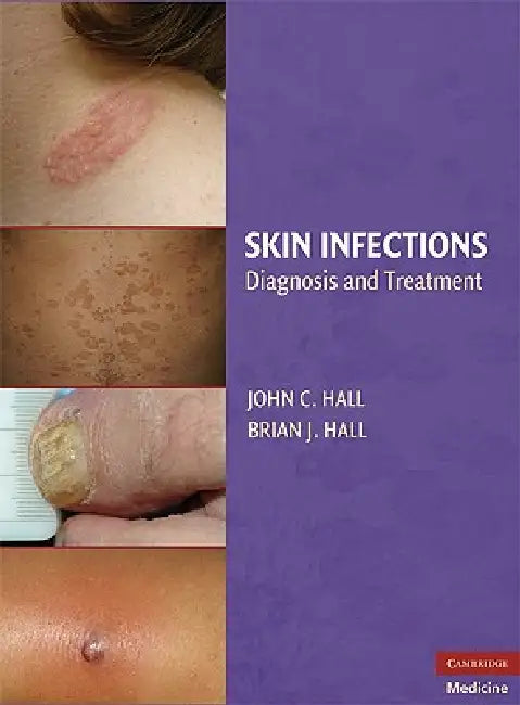 Skin Infections (English, John C. Hall | Brian J. Hall)